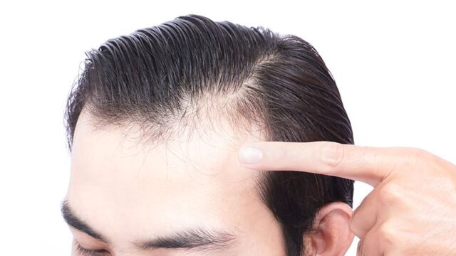 49 Cute How to regrow receding hairline male Combine with Best Outfit