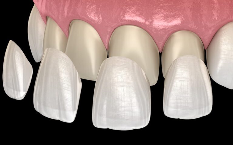 Getting Dental Veneers