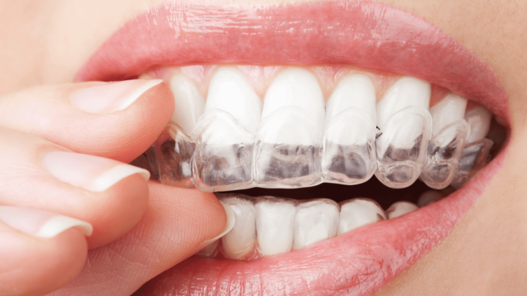 What Foods Should You Avoid To Get The Best Results From Your Invisalign?